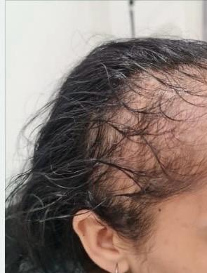 Vanity Clinic - Hair Loss Treatment