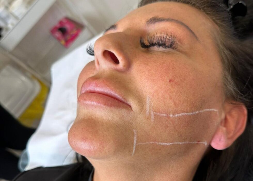 Vanity Clinic - PDO Threads Face Lift Treatment